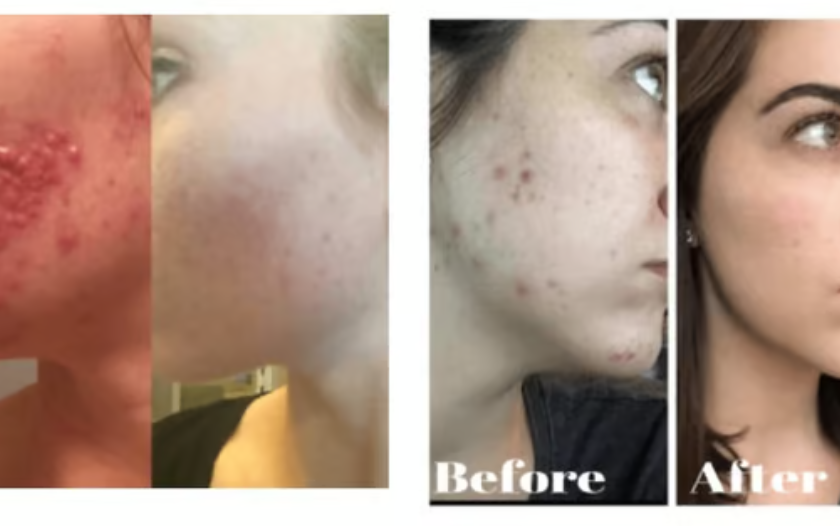 Clearstem Skincare Reviews : Does Clearstem Used Ingredients Work? See Customer Reviews, Complaints